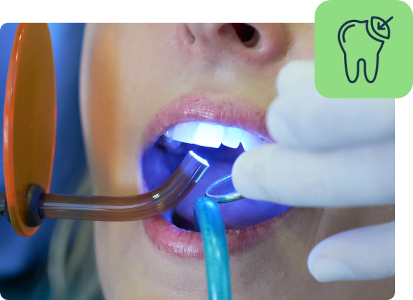 Application of Dental Fillings