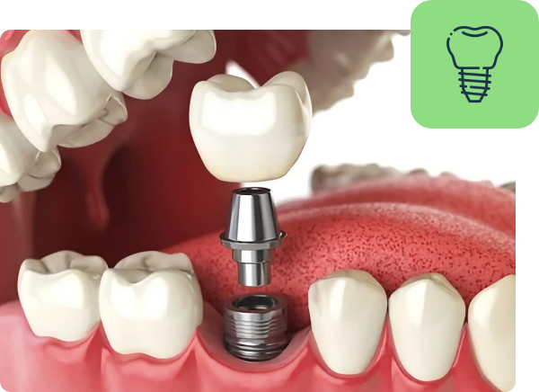 dental implant