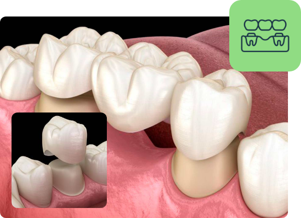 demonstration of Dental Bridges