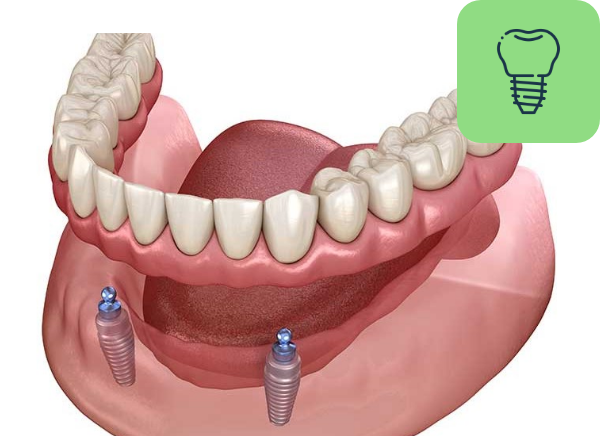 Overdentures