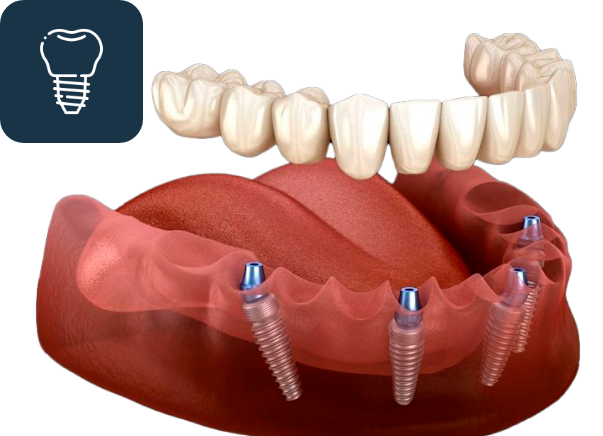 Overdenture Process at Alfonso Dental